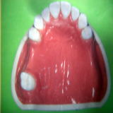 多数歯の歯の欠損