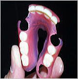 フレキシブル義歯