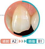 ホワイトニング前後３